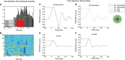 Deep Brain Stimulation Can Differentiate Subregions of the Human Subthalamic Nucleus Area by EEG Biomarkers